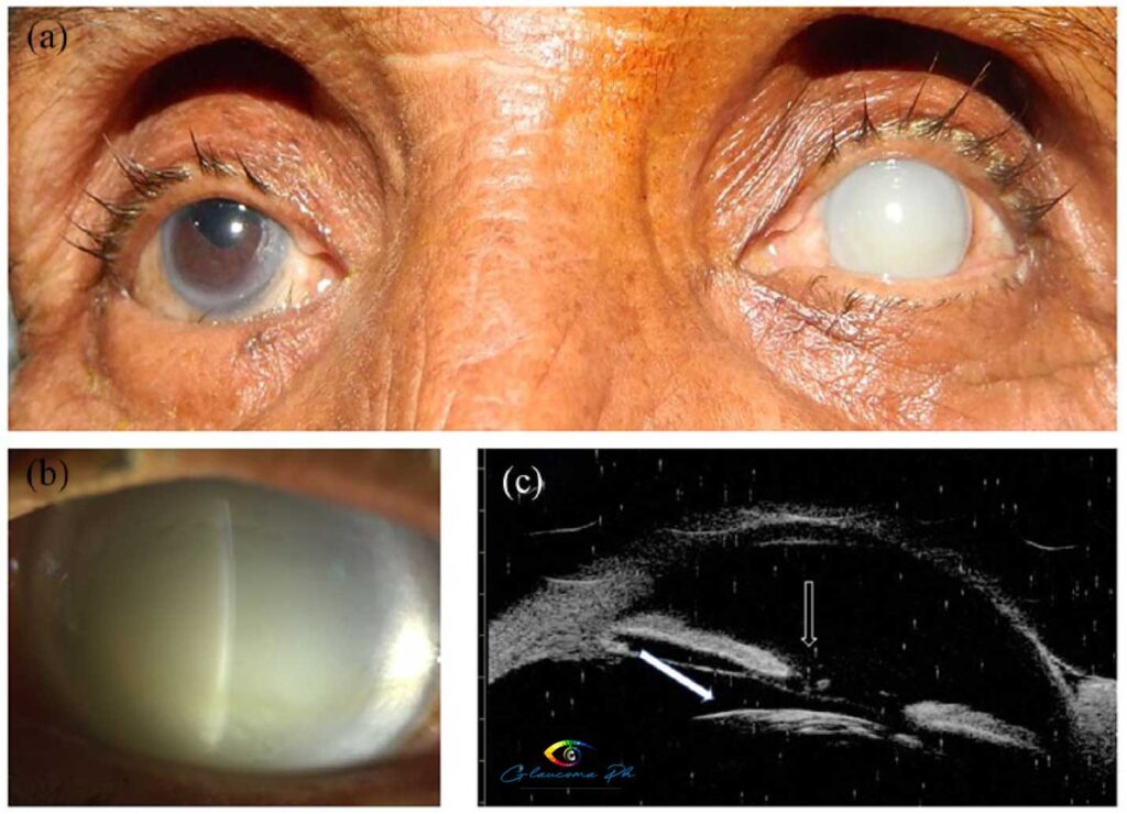 phacolytic-glaucoma-philippines