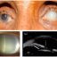 phacolytic-glaucoma-philippines